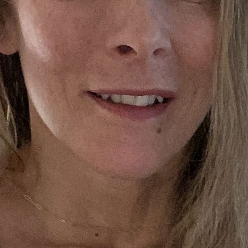 Customer photo review of CheekFix: Filler