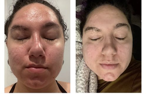 Customer photo review of UNVEIL ROSE CLAY MASK : Skin clearing, tightening and rejuvenating