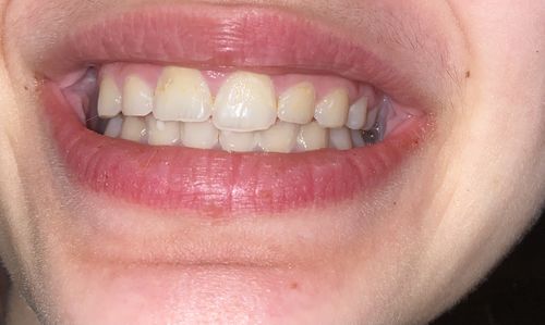 Customer photo review of PAP+ LED Teeth Whitening Kit