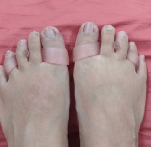 Customer photo review of BODYFEET ALIGNERS KIT