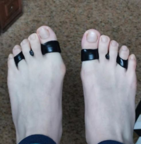Customer photo review of BODYFEET ALIGNERS KIT