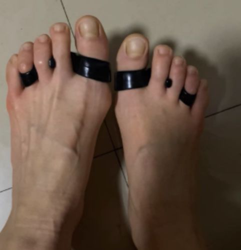 Customer photo review of BODYFEET ALIGNERS KIT