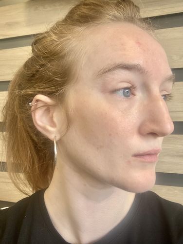 Customer photo review of The KLARSKIN Starter Pack