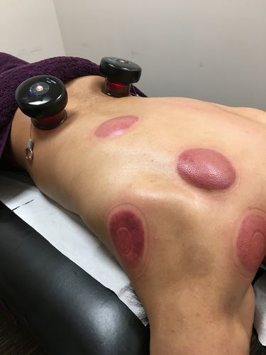 Customer photo review of Achedaway Cupper - The Smart Cupping Therapy Massager