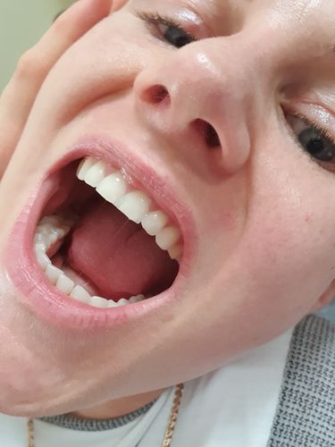 Customer photo review of PAP+ LED Teeth Whitening Kit