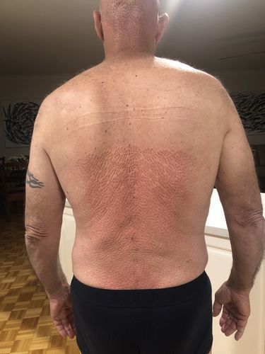 Customer photo review of BeyondVitality® Acupressure Mat & Pillow Set