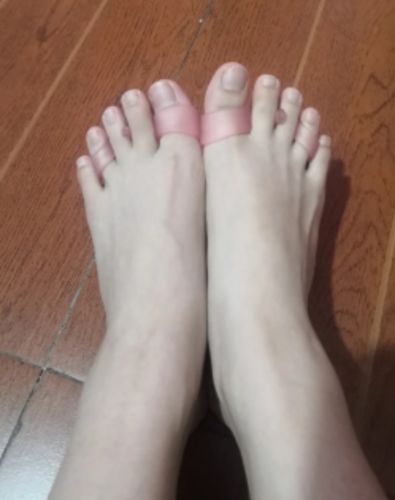 Customer photo review of BODYFEET ALIGNERS KIT