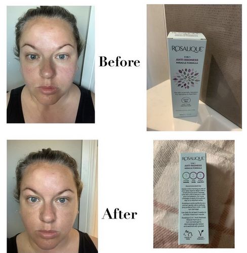 Customer photo review of Rosalique 3 in 1 Anti-Redness Miracle Formula SPF50