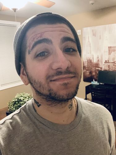 Customer photo review of 10% Tugain Foam Minoxidil Extra Strength Hair Regrowth for Men.