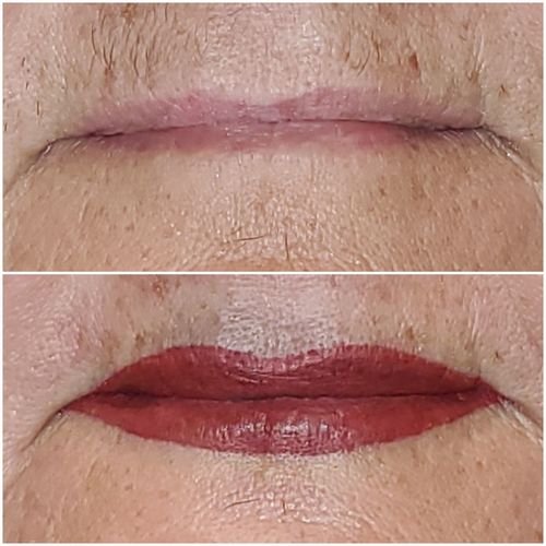 Customer photo review of Cooling Gel Lip Pad - PMU & Injectors