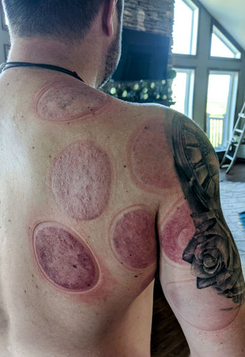 Customer photo review of Achedaway Cupper - The Smart Cupping Therapy Massager (Pair)