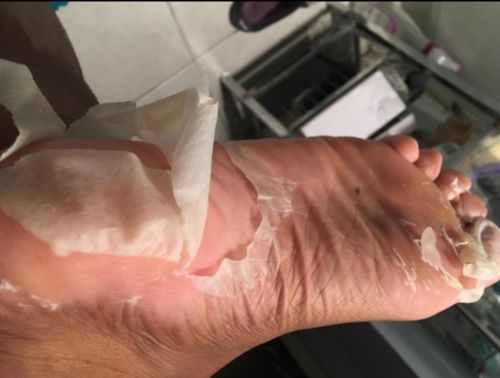 Customer photo review of Exfoliating Foot Peeling Mask by TOPQAC™