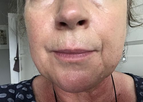 Customer photo review of Rosalique 3 in 1 Anti-Redness Miracle Formula SPF50