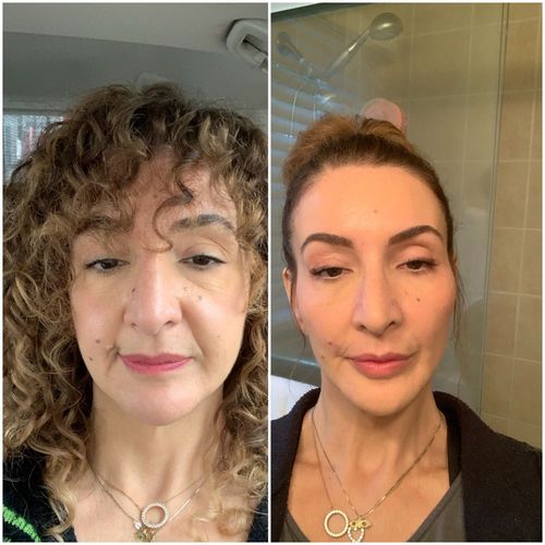 Customer photo review of WrinkleFix: Botox Membership
