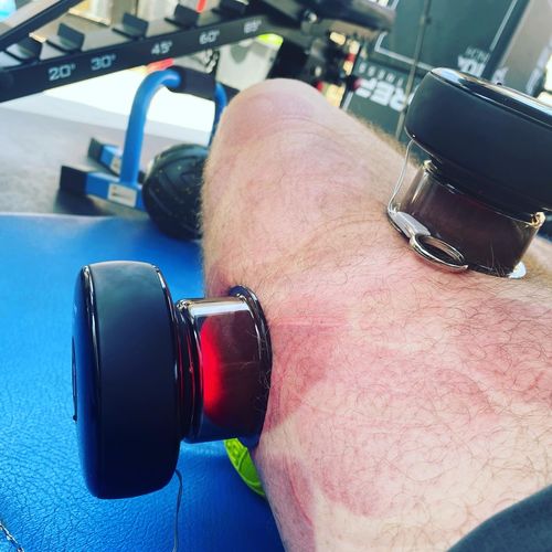 Customer photo review of Achedaway Cupper - The Smart Cupping Therapy Massager