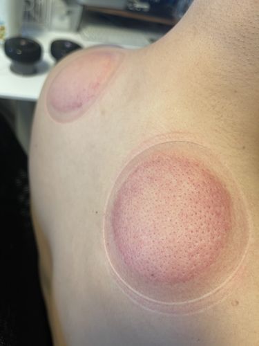 Customer photo review of Achedaway Cupper - The Smart Cupping Therapy Massager (Pair)