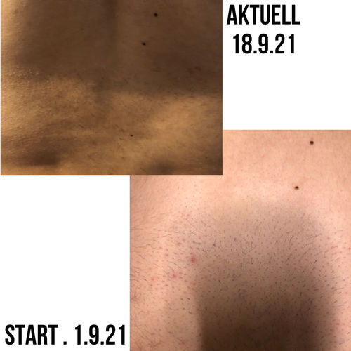 Customer photo review of WONDER SKIN HAIR REMOVAL ORGINAL CLASSIC PRO