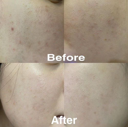 Customer photo review of Copper Peptide Mask