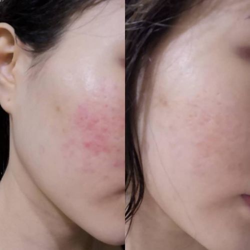 Customer photo review of Copper Peptide Mask