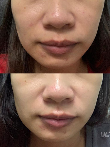 Customer photo review of Copper Peptide Mask
