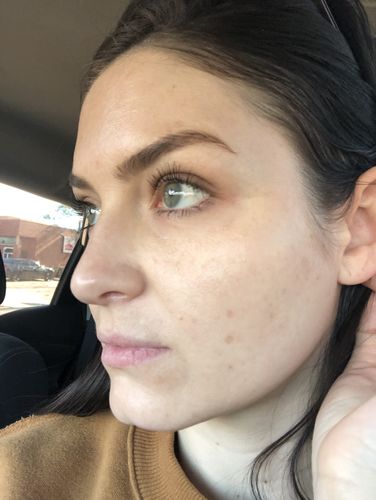 Customer photo review of Dr. Pen M8 Microneedling Pen