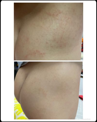 Customer photo review of Coco 濕疹修護霜套裝