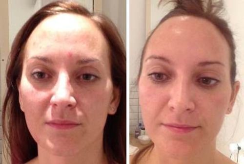 Customer photo review of OTWOO™- LED Maske