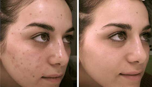 Customer photo review of OTWOO™- LED Maske