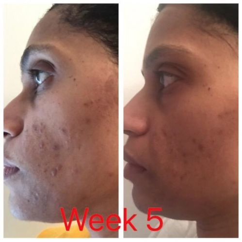 Customer photo review of OTWOO™- LED Maske