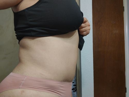 Customer photo review of Clarity Rose Stretchmark and Scar Healing Mask