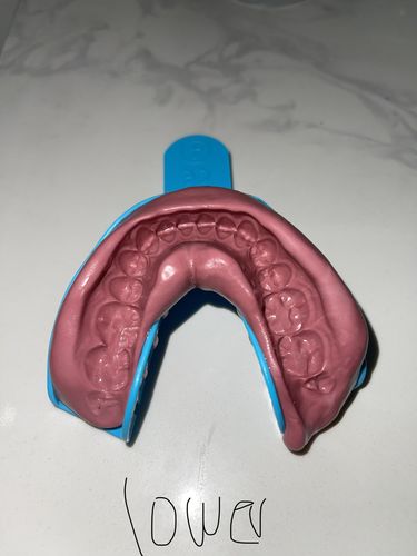 Customer photo review of Upper and Lower Retainers