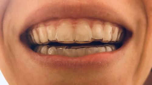 Customer photo review of Hard Night Guard