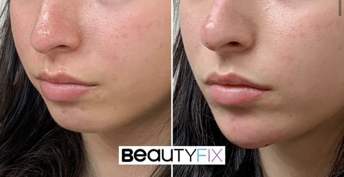 Customer photo review of ChinFix: Filler