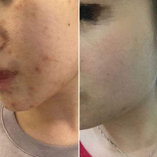 Customer photo review of Copper Peptide Mask