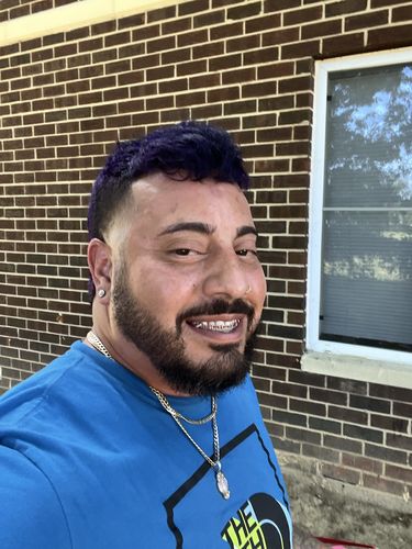 Customer photo review of 10% Tugain Foam Minoxidil Extra Strength Hair Regrowth for Men.