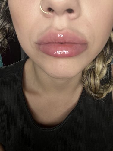 Customer photo review of LipFix: Filler