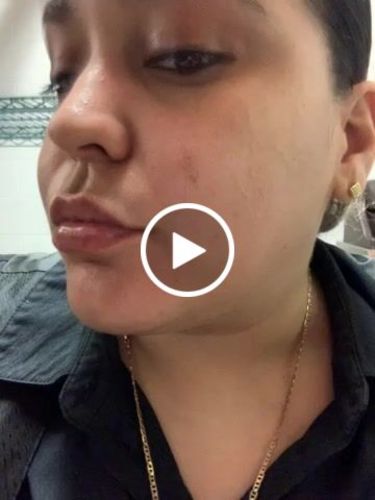 Customer video review of LipFix: Filler