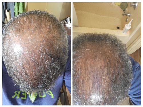 Customer photo review of Herbal Hair/Beard Growth Oil..