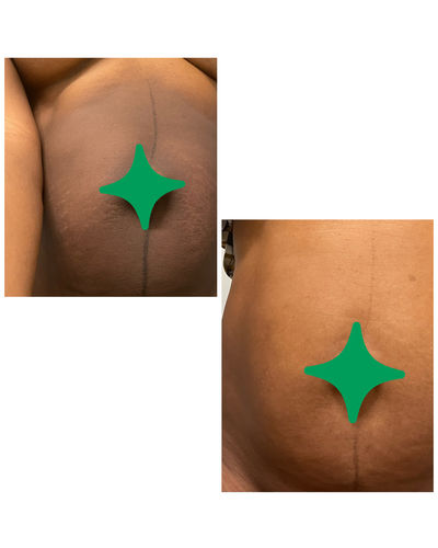 Customer photo review of Pro-Advance whitening System