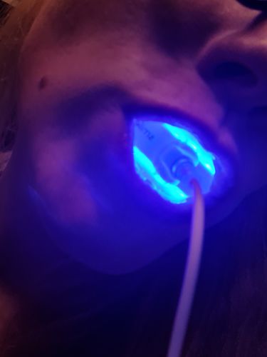 Customer photo review of Refill Whitening Gel