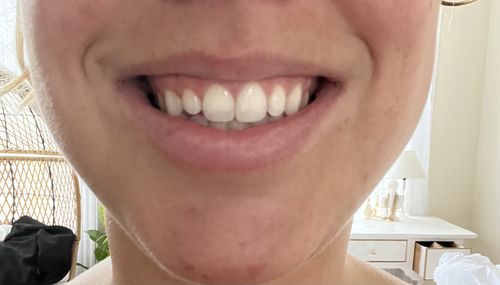 Customer photo review of LipFix: Gummy Smile
