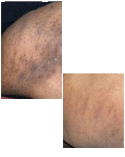 Customer photo review of Intense Discoloration Treatment- Quickly fade unwanted marks such as face, elbow, dark underarms, bikini areas, Melasma, etc(Strong Formula)