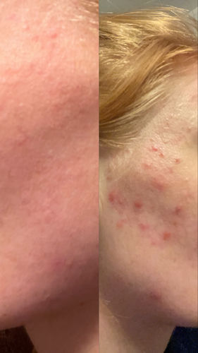 Customer photo review of The KLARSKIN Starter Pack