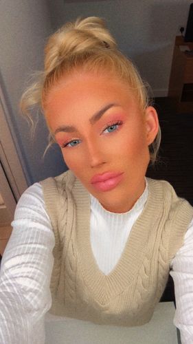 Customer photo review of SL70 Blue Contact Lenses(12 months wear)
