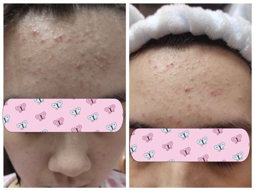 Customer photo review of POMEGRANATE INSTANT CALMING MASK (100g)