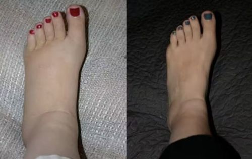 Customer photo review of PuriMe Lymphatic Drainage Ginger Foot Soak