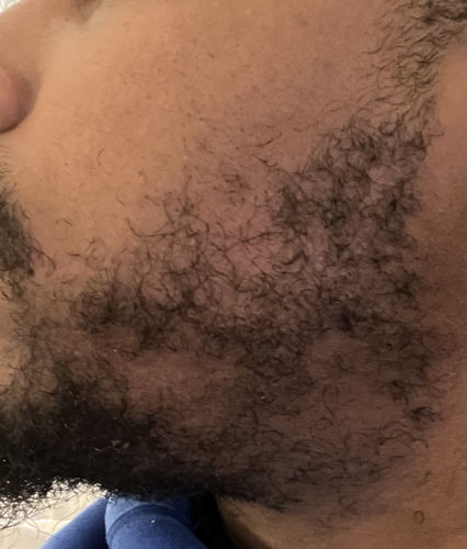 Customer photo review of Tugain 10% Minoxidil Extra Strength Topical Solution for Men.