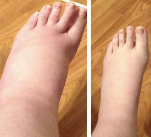 Customer photo review of PuriMe Lymphatic Drainage Ginger Foot Soak