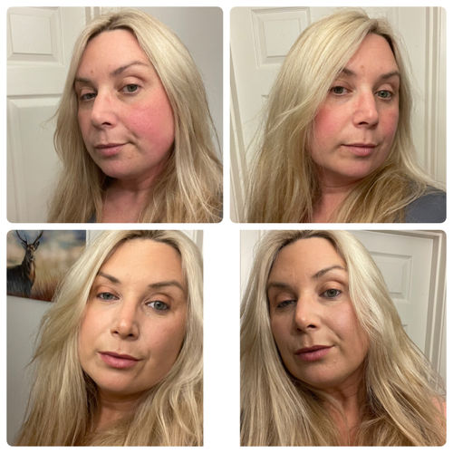 Customer photo review of Rosalique 3 in 1 Anti-Redness Miracle Formula SPF50