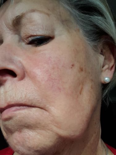 Customer photo review of Rosalique 3 in 1 Anti-Redness Miracle Formula SPF50